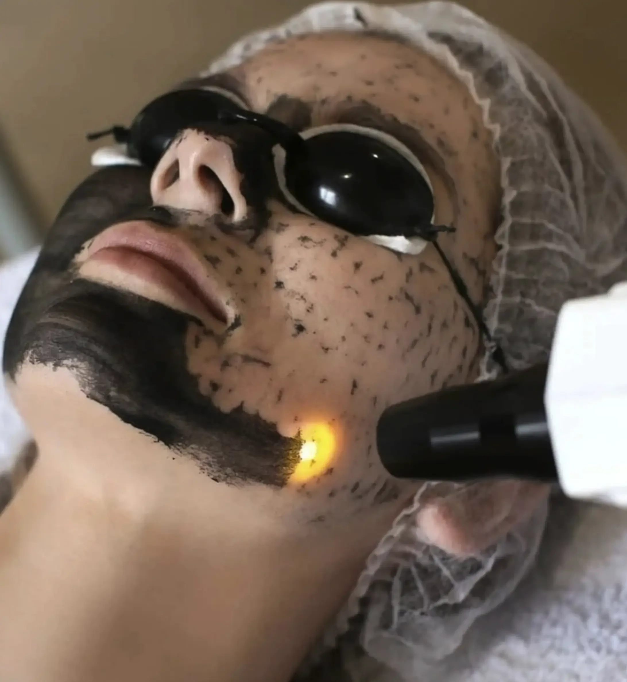 Carbon laser peel treatment — charcoal mask applied with protective goggles worn