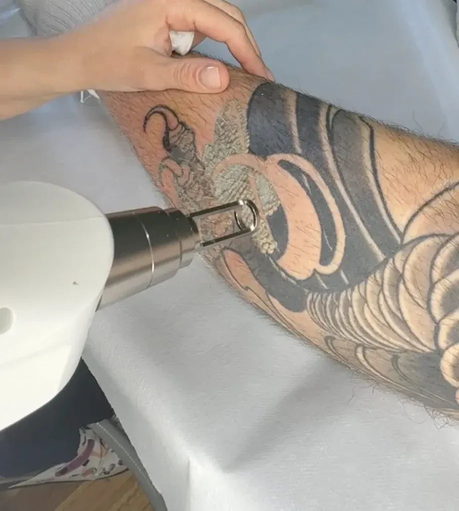 Laser tattoo removal session — handpiece held over sleeve tattoo on arm
